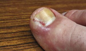 Эффективные методы лечения нарыва на пальце ноги в домашних условиях