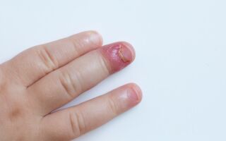 Лечение панариция на пальце руки у детей