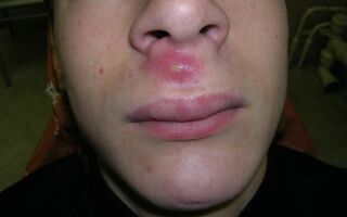 Причины, симптомы и способы лечения фурункула на лице