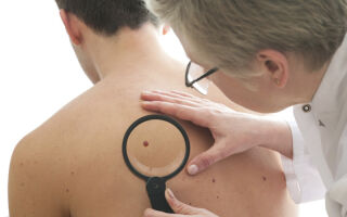 Причины появления бородавок на спине и способы их лечения