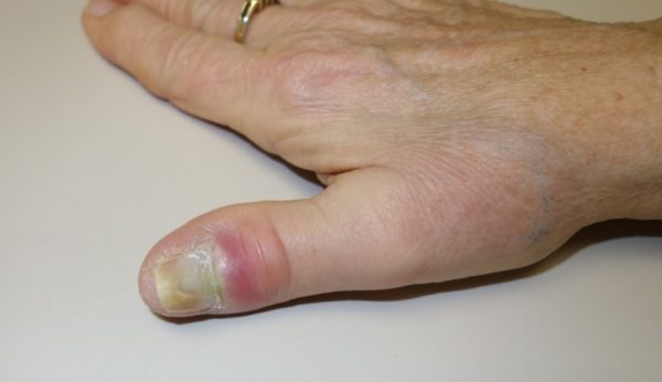 Заболевания кожи рук и ногтей 30