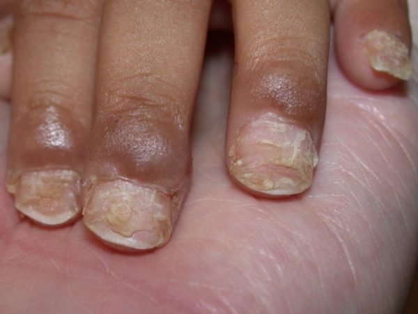 Заболевания кожи рук и ногтей 32
