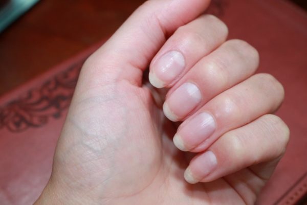 Диагностика по ногтям пальцев рук 58