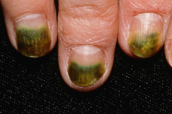 Диагностика по ногтям пальцев рук 61