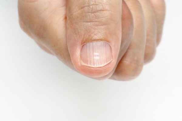 Диагностика по ногтям пальцев рук 62