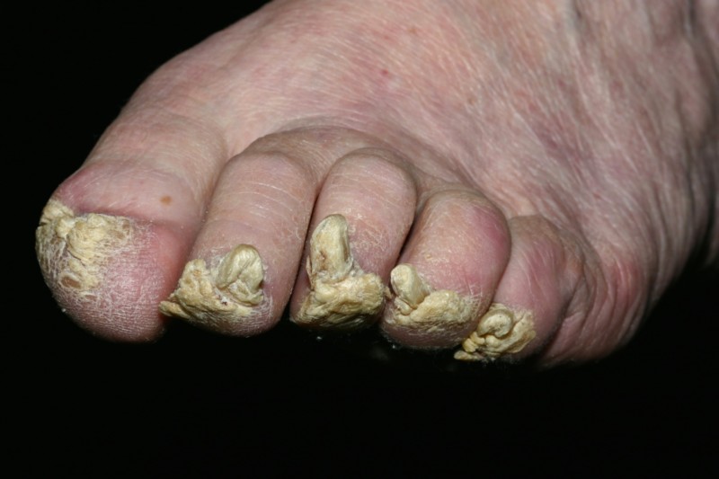 Утолщение ногтевой пластины на ногах причина 22